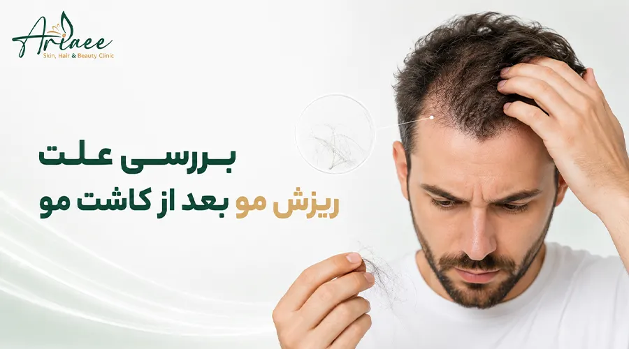 بررسی علت ریزش مو بعد از کاشت مو