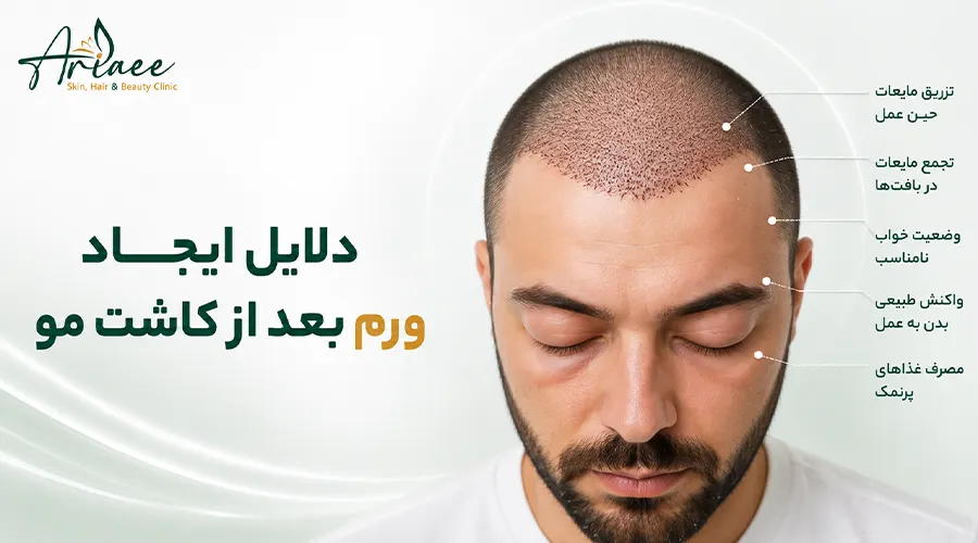 دلایل ایجاد ورم بعد از کاشت مو