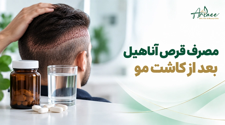 مصرف قرص آناهیل بعد از کاشت مو