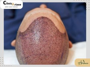  ۴۰ روز بعد از کاشت مو