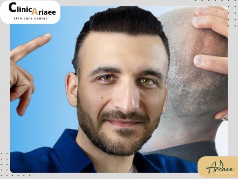  آیا کاشت مو دائمی است؟
