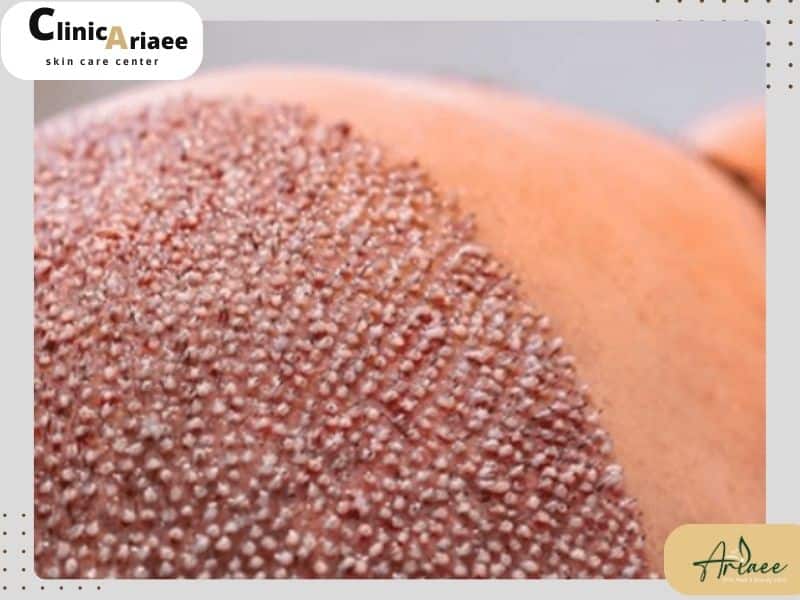 دلمه های بعد از کاشت مو