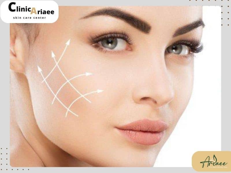  ماندگاری نتایج در اندولیفت و لیفت با نخ