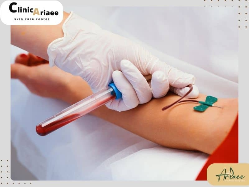 آزمایش HIV