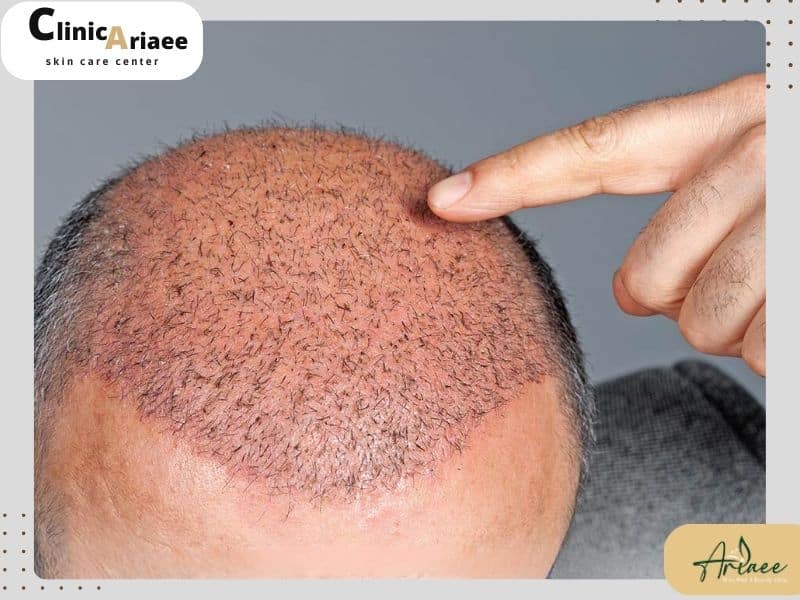  آیا می‌توان بعد از کاشت مو به هتل یا خانه رفت؟
