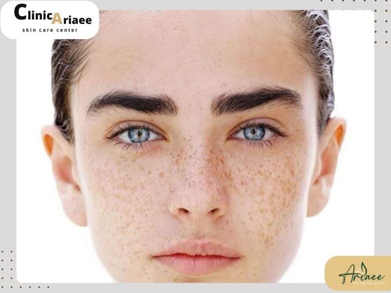  دلایل خارش بعد از کاشت ابرو