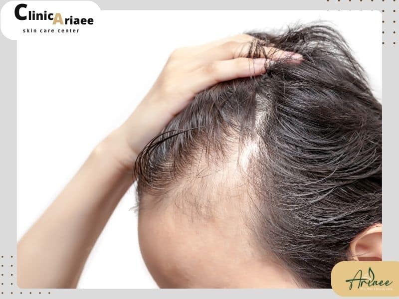 پیشگیری از ریزش موی ارثی