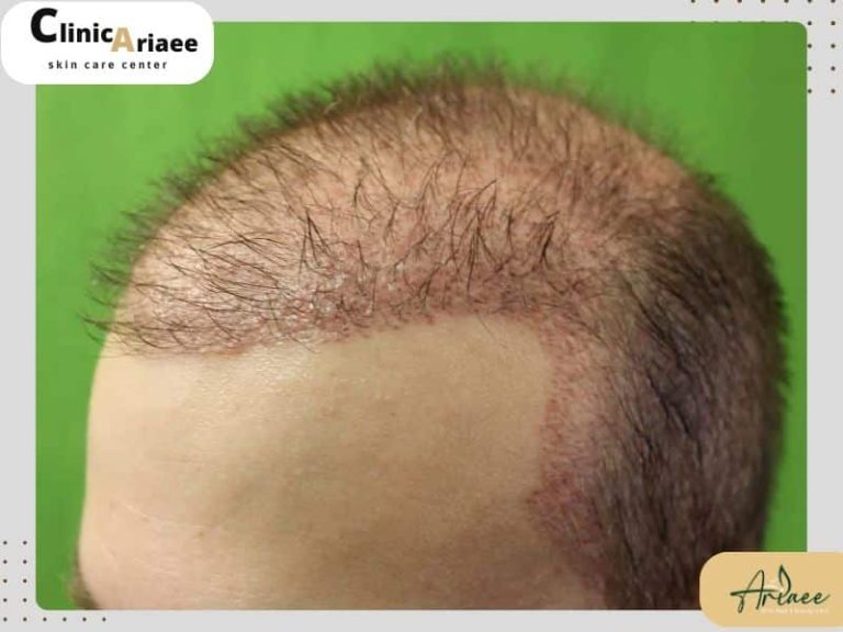  فاز استراحت موهای کاشته شده