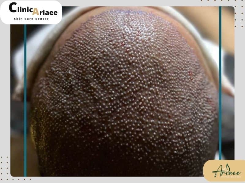  نتایج و تأثیرات دائمی کاشت مو با سلول‌های بنیادی  (FCI)