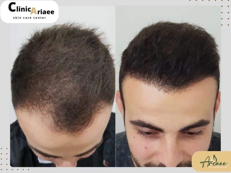  مدت زمان فاز استراحت مو بعد از کاشت