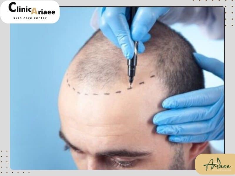  هزینه کاشت مو در سال ۱۴۰۳