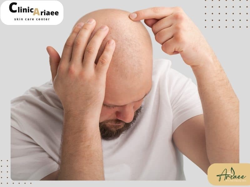کاشت مو برای چه کسانی مناسب نیست؟