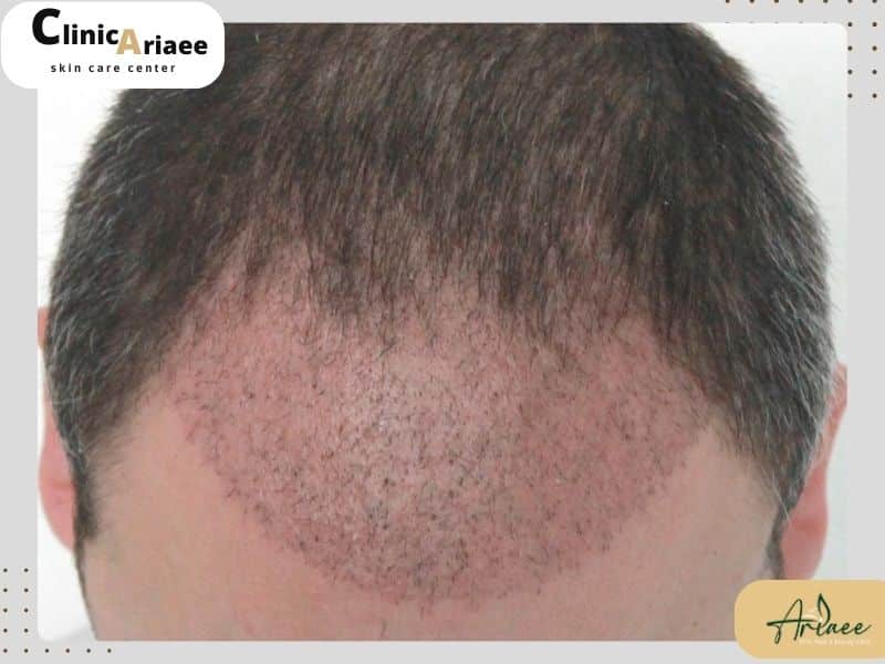  ۳ نکته کلیدی برای دستیابی به بهترین نتیجه از کاشت مو