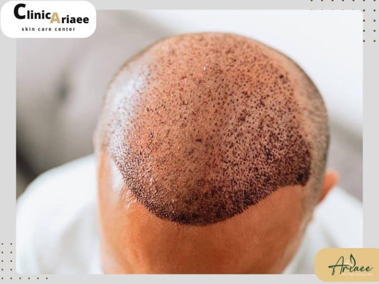  عفونت سر بعد از کاشت مو