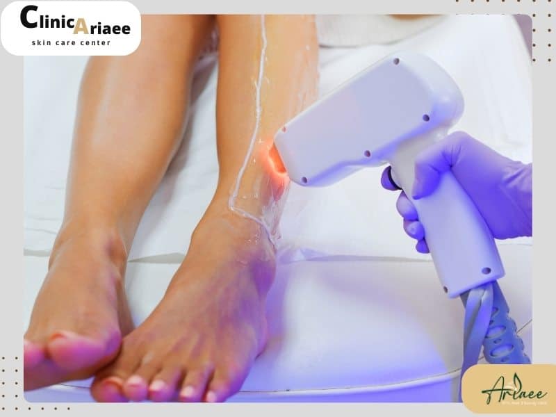 عواقب افزایش فاصله بین جلسات لیزر