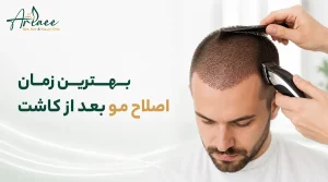بهترین زمان اصلاح مو بعد از کاشت
