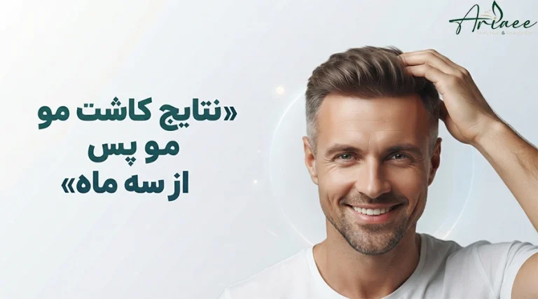 نتایج کاشت مو پس از سه ماه