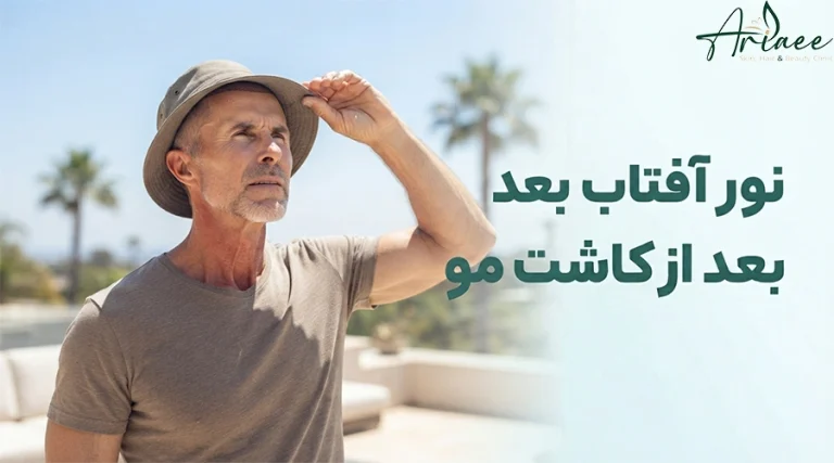 نور آفتاب بعد از کاشت مو
