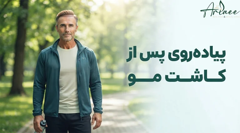 پیاده_روی پس از کاشت مو