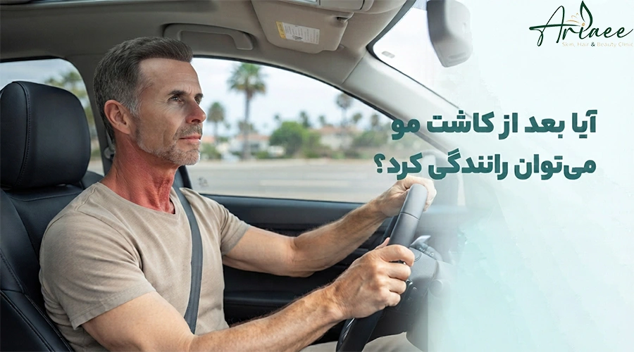 _آیا بعد از کاشت مو می _توان رانندگی کرد؟