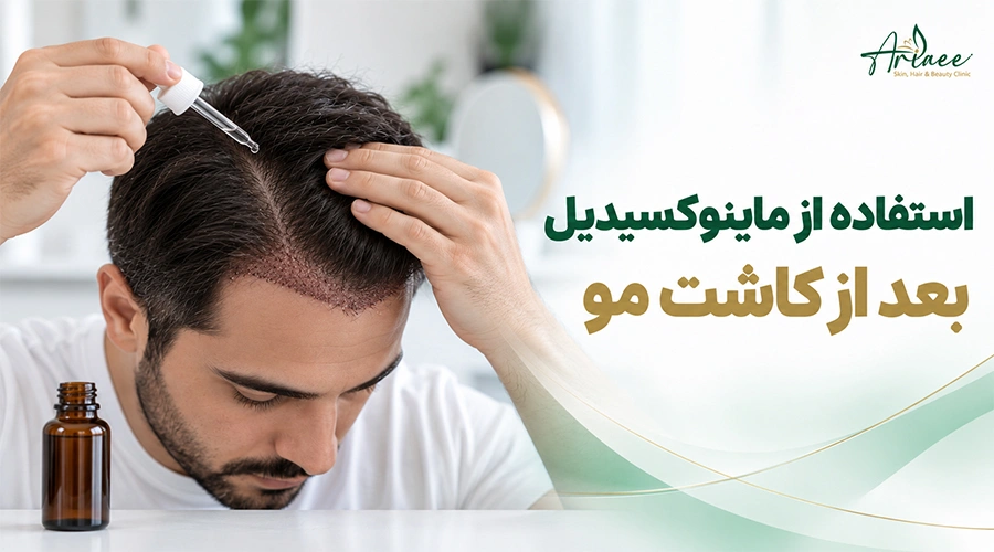 استفاده از ماینوکسیدیل بعد از کاشت مو