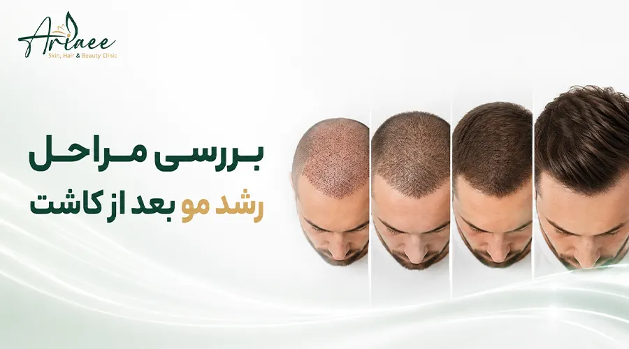 بررسی مراحل رشد مو بعد از کاشت