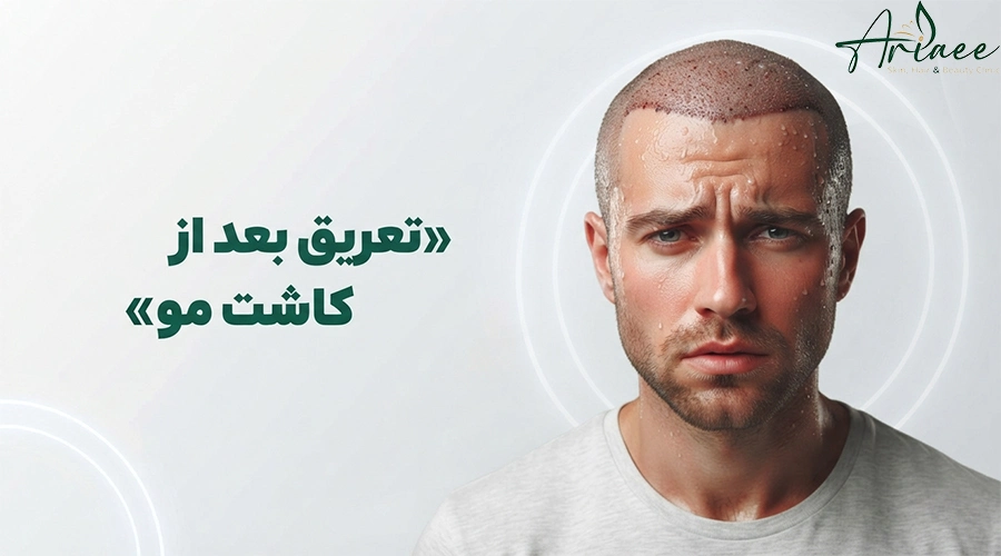 تعریق بعد از کاشت مو