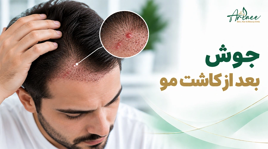 جوش بعد از کاشت مو