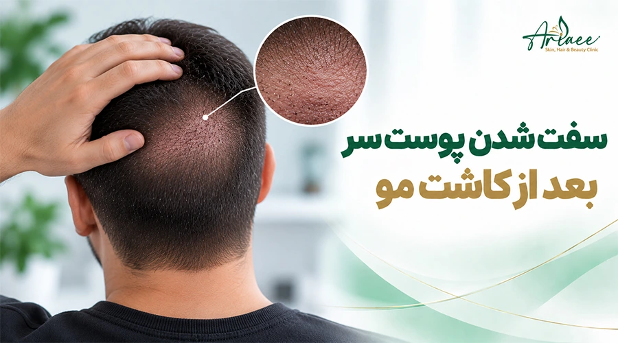 سفت شدن پوست سر بعد از کاشت مو