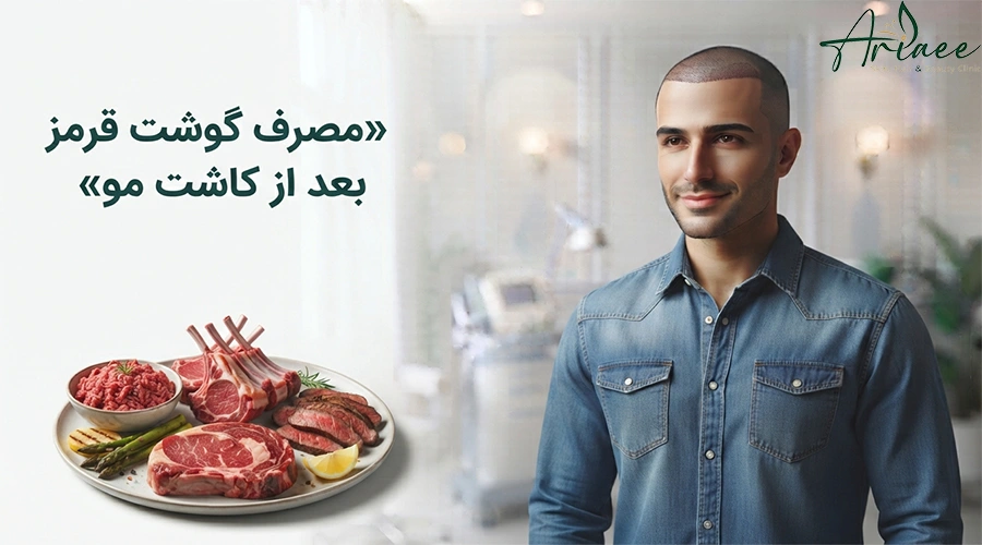 مصرف گوشت قرمز بعد از کاشت مو