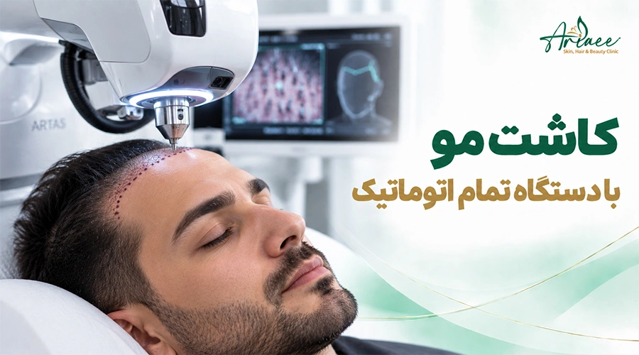 کاشت مو با دستگاه تمام اتوماتیک