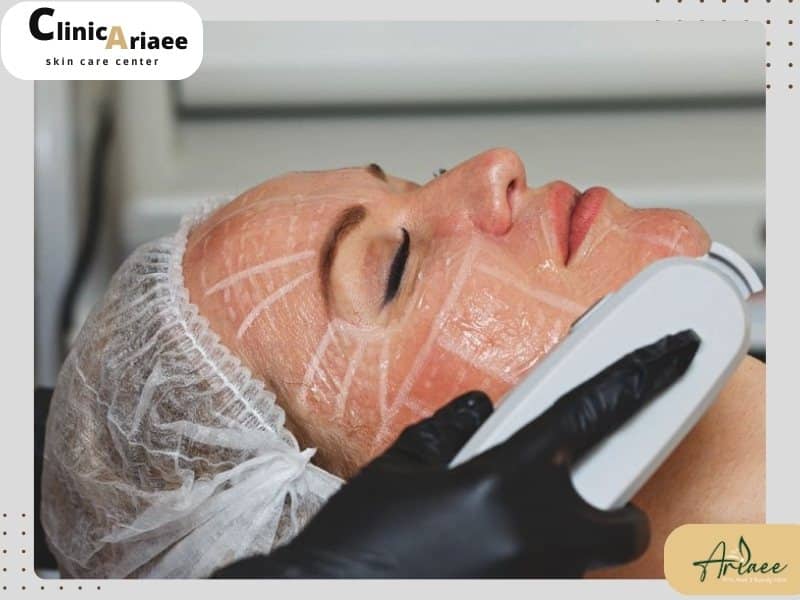 بهترین نتیجه برای رفع چینوچروک پوست؛ ۳ جلسه هایفو
