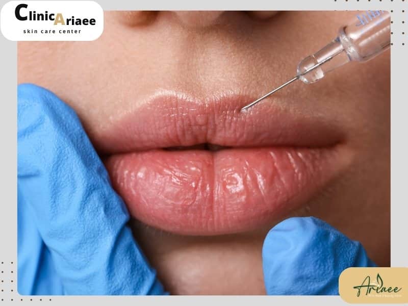 قیمت تزریق ژل لب