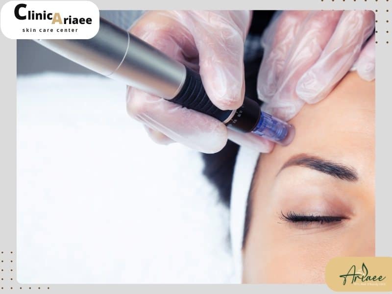 ویژگیهای بهترین مرکز میکرونیدلینگ