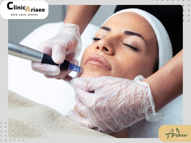 چرا مراجعه به بهترین مرکز میکرونیدلینگ اهمیت دارد؟