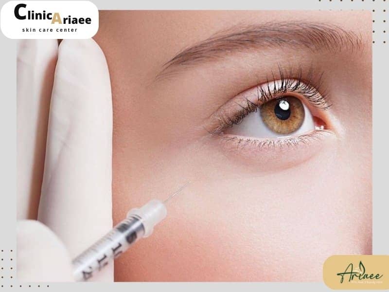 راه‌های پیشگیری از کبودی و ورم فیلر زیر چشم قبل از تزریق