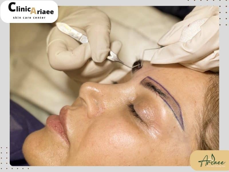  کاشت ابرو در بارداری