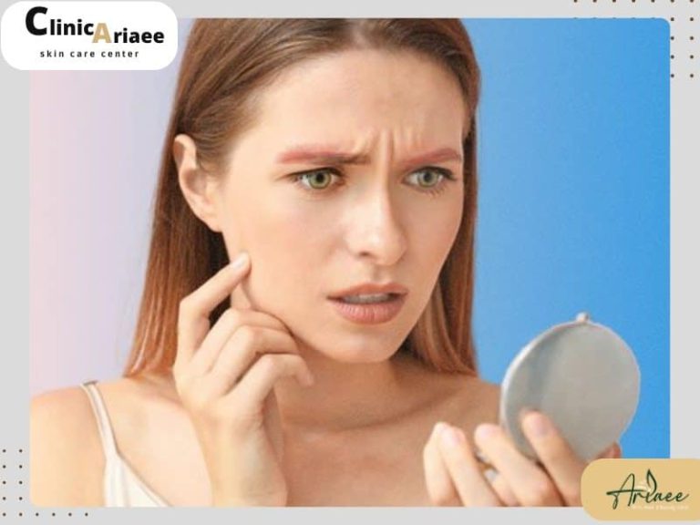 زخم و قرمزی بعد از ریموو ابرو