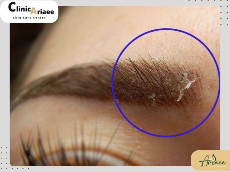 پوسته پوسته شدن ابرو بعد از کاشت