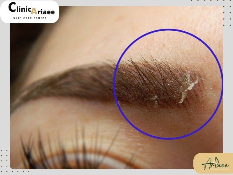 پوسته پوسته شدن ابرو بعد از کاشت