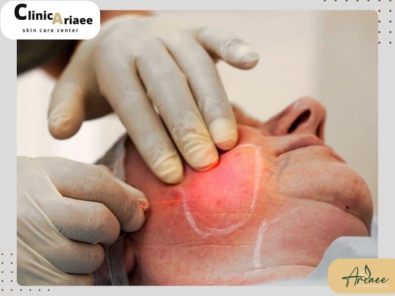  هزینه اندولیفت در تهران چقدر است؟ 