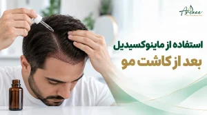 استفاده از ماینوکسیدیل بعد از کاشت مو