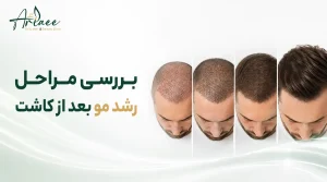 بررسی مراحل رشد مو بعد از کاشت