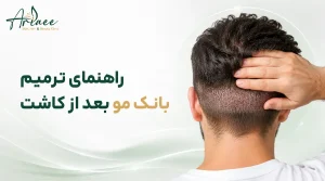 ترمیم بانک مو بعد از کاشت