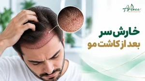 خارش سر بعد از کاشت مو