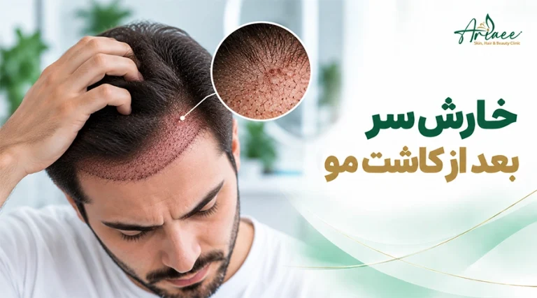 خارش سر بعد از کاشت مو