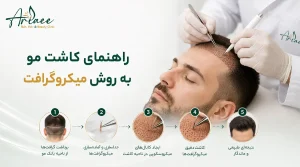 راهنمای کاشت مو به روش میکروگرافت