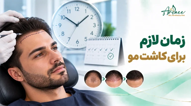 زمان لازم برای کاشت مو