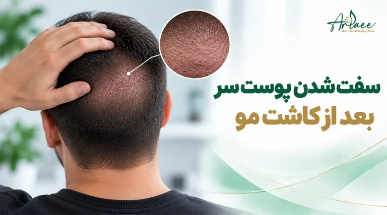 سفت شدن پوست سر بعد از کاشت مو