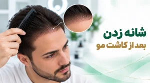 شانه زدن بعد از کاشت مو